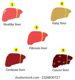 Stages of liver damage hand drawing. Study content for medcine students. Vector illustration.