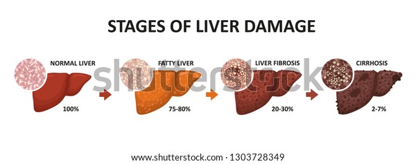 Stages Liver Damage Healthy Fatty Liver Stock Vector (Royalty Free ...