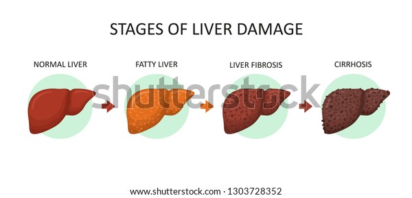 Stages Liver Damage Healthy Fatty Liver Stock Vector (Royalty Free ...