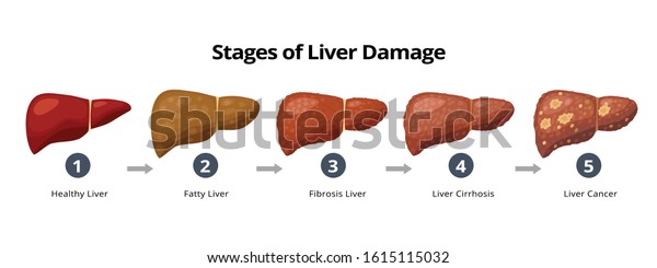 Stages of liver\
damage from healthy, fatty liver, fibrosis, cirrhosis to liver\
cancer. Medical infographic, liver diseases icons in flat design\
isolated on white\
background.