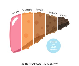 Stages of liver damage include steatosis or fatty liver, fibrosis, cirrhosis and cancer or hepatocellular carcinoma . Flat design . Vector .