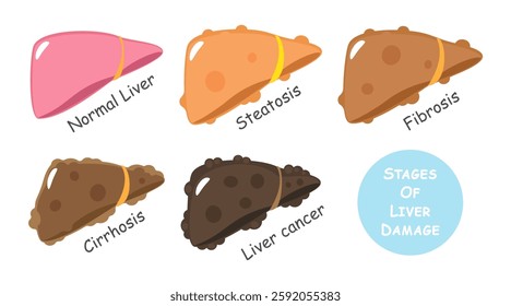 Stages of liver damage include steatosis or fatty liver, fibrosis, cirrhosis and cancer or hepatocellular carcinoma . Flat design . Vector .