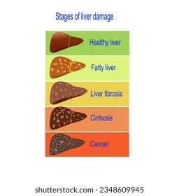 Stages of liver damage infographic concept , vector illustration