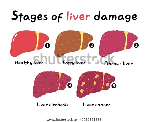 Stages Liver Damage Infographic Vector Hand Stock Vector (Royalty Free ...