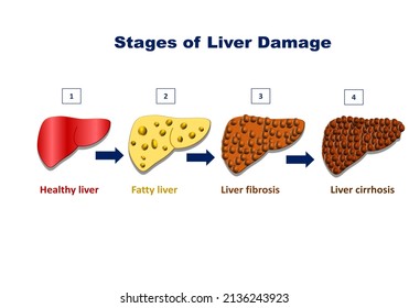 Stages of liver damage, liver injury steps Healthy, fatty liver steatosis, fibrosis and cirrhosis of liver. Vector illustration isolated on white background