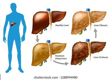 367 Steatosis Images, Stock Photos & Vectors | Shutterstock