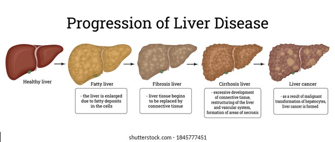 549 Stages liver disease Images, Stock Photos & Vectors | Shutterstock