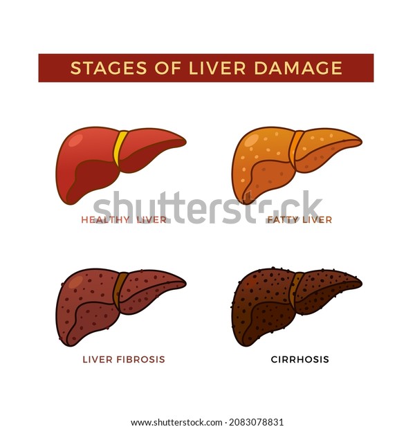 Stages Liver Damage Vector Illustration Stock Vector Royalty Free