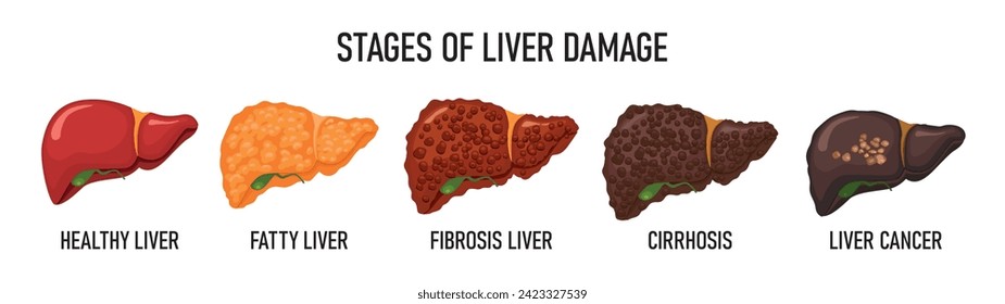 Stages of liver destruction. Medical poster with liver. Set of liver vector illustration on a medical theme