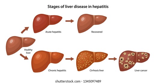 Liver disease svg