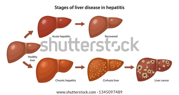 Stages Liver Disease Hepatitis Description Corresponding Stock Vector ...