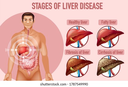 Stages of liver disease illustration