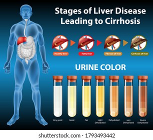 Stages of liver disease illustration