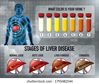 Stages Liver Disease Illustration Stock Vector (Royalty Free) 1795482544