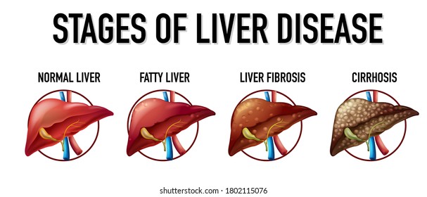 Stages of liver disease illustration