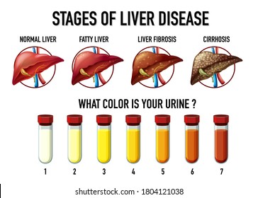 Stages Of Liver Disease Illustration