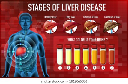 2,129 Fatty liver infographic Images, Stock Photos & Vectors | Shutterstock