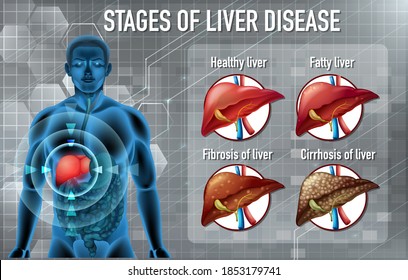 Stages Liver Disease Illustration Stock Vector (Royalty Free ...