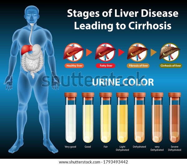 Stages Liver Disease Illustration Stock Vector (Royalty Free ...