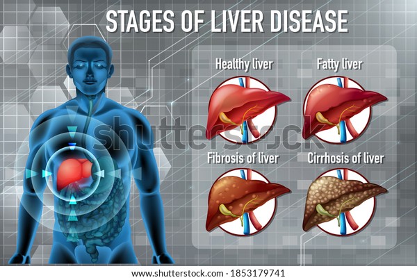 Stages Liver Disease Illustration Stock Vector (Royalty Free ...