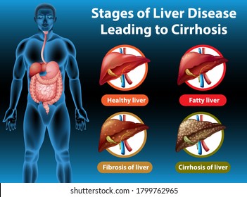 Stages Liver Disease Leading Cirrhosis Illustration Stock Vector ...