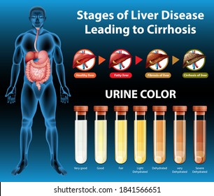 Stages Of Liver Disease Leading To Cirrhosis Illustration