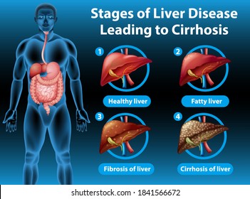 Stages Of Liver Disease Leading To Cirrhosis Illustration