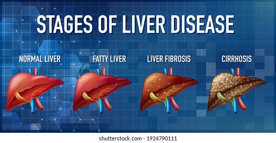 Stages Of Liver Disease Leading To Cirrhosis Illustration