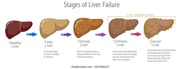 Stages Liver Failure, Cancer, Transplant Disease Steps. Annotated, Explanations. Progression, Healthy Normal Liver, Fatty Fibrosis, Cirrhosis, ESLD. Medical, Human Organs. Vector Illustration