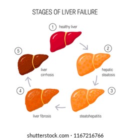 549 Stages liver disease Images, Stock Photos & Vectors | Shutterstock