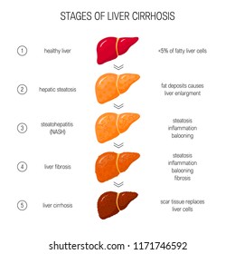 111 Non alcoholic fatty liver disease Images, Stock Photos & Vectors ...