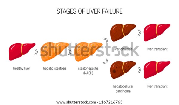 Stages Liver Failure Concept Vector Illustration Stock Vector (Royalty ...