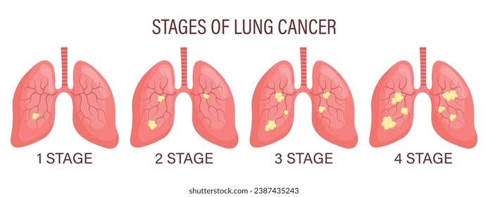 Etapas de cáncer de pulmón, enfermedad pulmonar. Banner de infografía médica, ilustración, vector