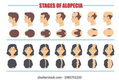 Stages of male and female alopecia vector illustrations set. Tops of heads of man and woman, bald spots on scalp, process of hair loss isolated on white background. Alopecia, health concept