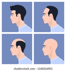 Stages of male pattern baldness. Hair loss. Alopecia. Asian men. Set. Vector Flat Illustration