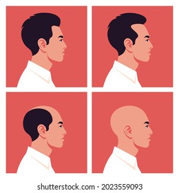 Stages of male pattern baldness. Hair loss. Alopecia. Profiles of Asian men. Vector flat Illustration