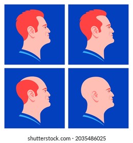 The stages of male pattern baldness. Hair loss. Alopecia. Profiles of European men. Vector flat Illustration
