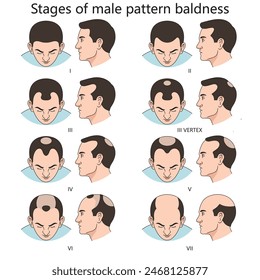 Stages of male pattern baldness, showing progressive hair loss from stage I to stage VII diagram hand drawn schematic vector illustration. Medical science educational illustration