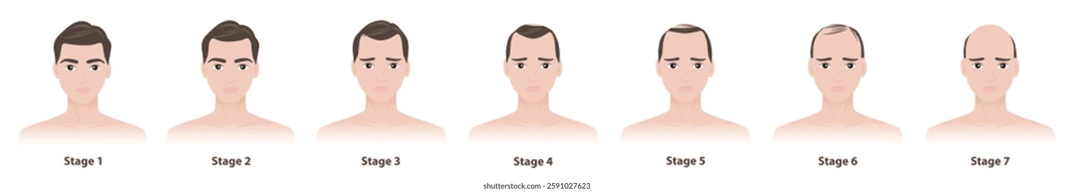 The stages of male pattern hair loss vector illustration isolated on white background. The Norwood scale defines seven stages of male pattern baldness or androgenetic alopecia. Hair care concept.