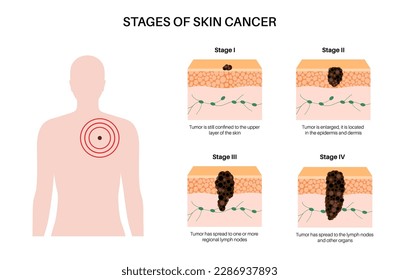 Stages of melanoma skin cancer development and progression. Malignant tumor growth into the skin layers from epidermis to other internal organs. Diagnostic and treatment in dermatology clinic vector