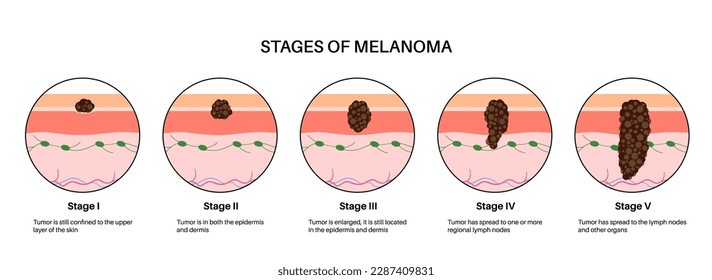 Stages of melanoma skin cancer development and progression. Malignant tumor growth into the skin layers from epidermis to other internal organs. Diagnostic and treatment in dermatology clinic vector