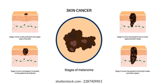 Etapas de desarrollo y progresión del cáncer de piel de melanoma. Crecimiento tumoral maligno en las capas cutáneas desde epidermis a otros órganos internos. Diagnóstico y tratamiento en vector clínico dermatológico