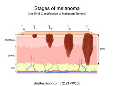 Stages Of Melanoma. The TNM Classification Of Malignant Tumors. Metastasis Of Skin Cancer. Malignant Melanoma. Vector Diagram