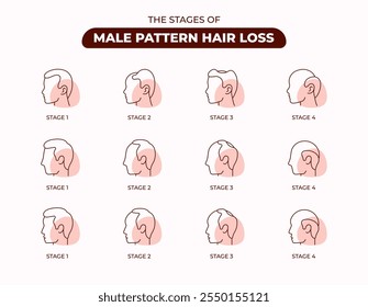 Os estágios de homens perda de cabelo linha ícone conjunto, folículo de cabelo, transplante, cabelo saudável, estágio, clínica, alopecia, curso editável.