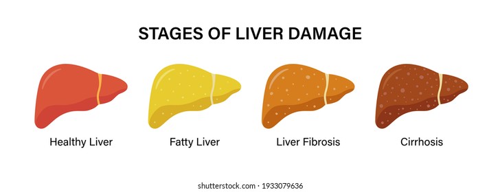 Stages of nonalcoholic liver damage. Healthy, fatty, fibrosis, cirrhosis. Liver Disease. Isolated vector illustration in flat style on white background
