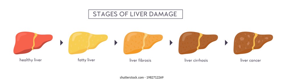 Stages of nonalcoholic liver damage. Healthy, fatty, steatosis, NASH, fibrosis, cirrhosis, cancer. Medical infographic of Liver Disease. Vector banner in flat cartoon style on white background.