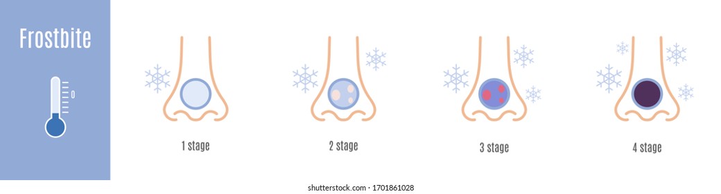 Stages Of Nose Frostbite. Hypothermia. Medical Infographic