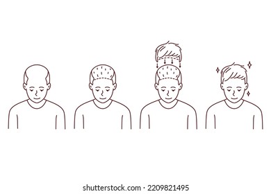 Stages on man hair transplant. Treatment of baldness and alopecia. Set of male patient follicular unit extraction. Vector illustration. 