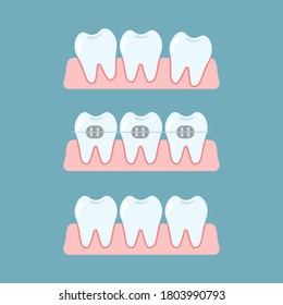 Stages of orthodontic treatment braces on teeth. Alignment of bite of teeth, dental row  with braces,  Orthodontic, stomatology concept. Vector flat cartoon illustration