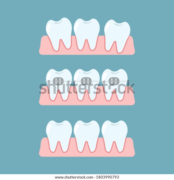 Stages Orthodontic Treatment Braces On Teeth Stock Vector (Royalty Free ...